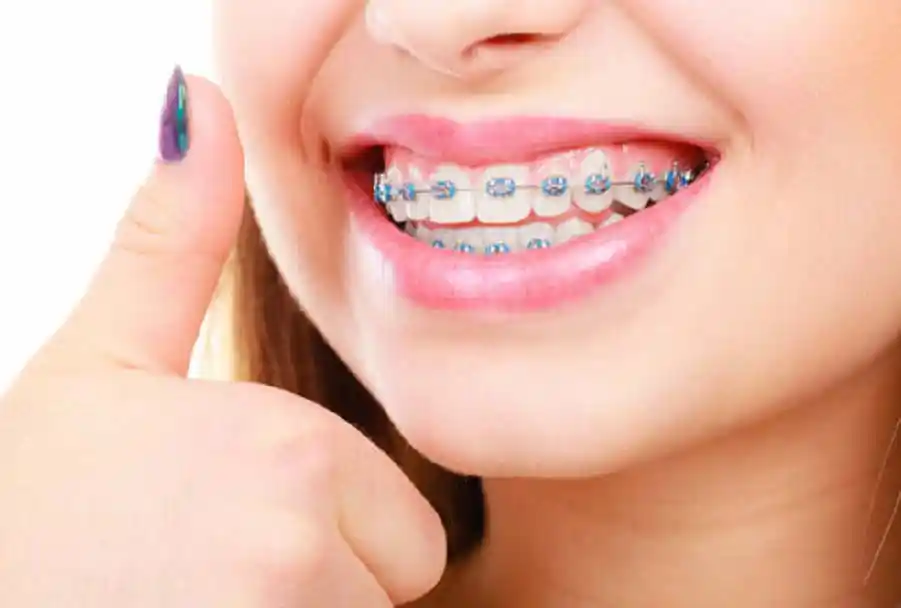 Teeth braces
